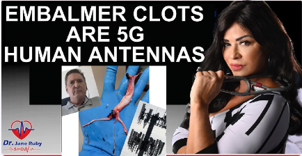 BOMBSHELL: PROOF EMBALMER CLOTS ARE 5G CONTROLLED HUMAN ANTENNAS